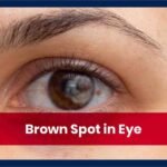 Black Spot in the Eye: Causes Symptoms and Treatment